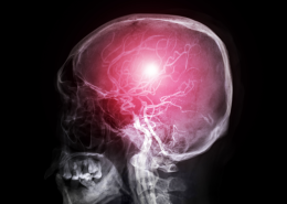Cerebral arteries, MRI angiogram