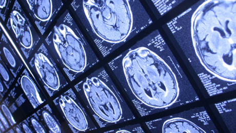 brainscan